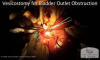 Watch: Vesicostomy for Bladder Outlet Obstruction.